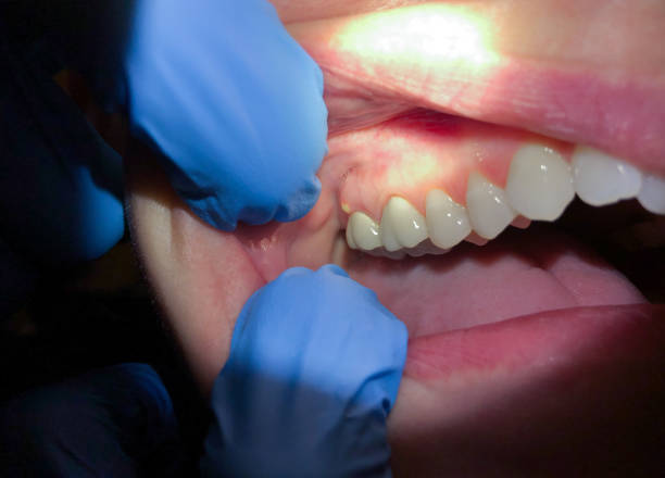 Best Emergency Dental Care for Abscessed Tooth in Gatlinburg, TN